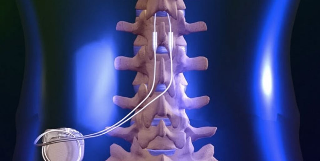 Spinal Cord Stim Pic.png