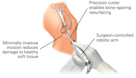 Joint_Replacement_Bllog_Pic.png