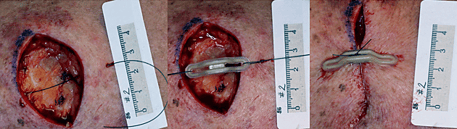 SUTUREGARD wound photo